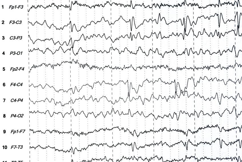 Image of an EEG scan shown in wave format.