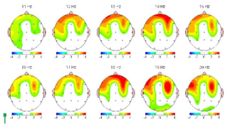 Image of a QEEG brain scan before neurofeedback treatment.