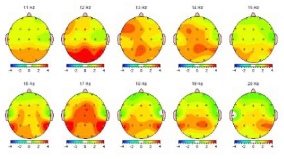 Image of a QEEG brain scan beofre neurofeedback therapy