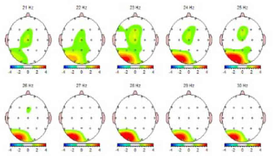 Image of a QEEG brain scan before neurofeedback therapy for TBI